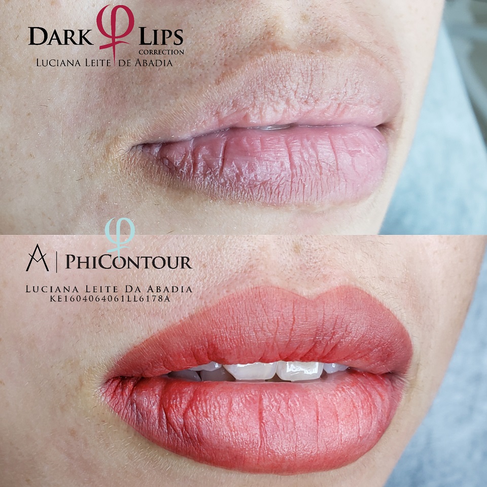 Procedimento de Neutralização Labial