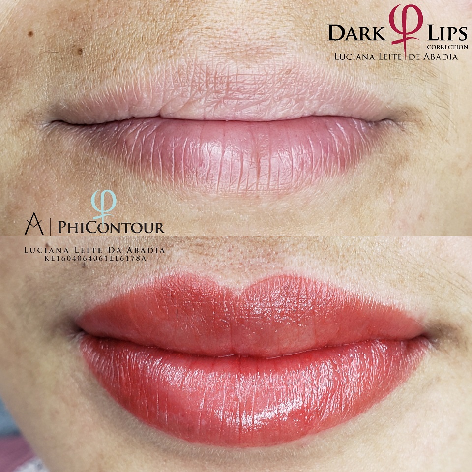 Procedimento de Neutralização Labial