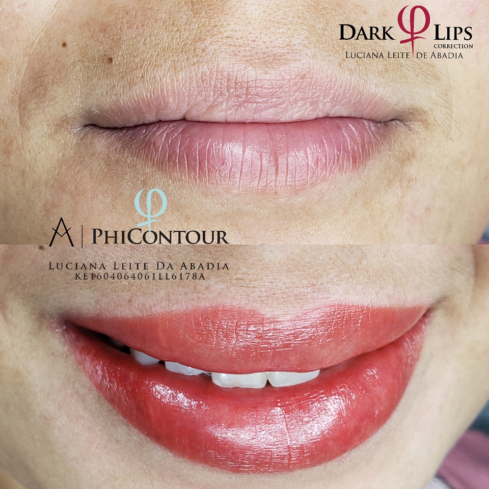 Procedimento de Neutralização Labial